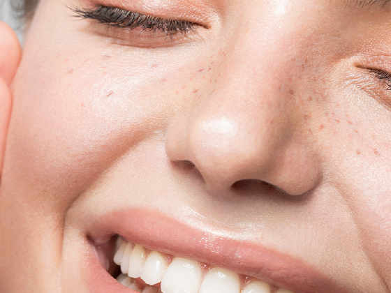 A close-up of a person's face highlighting their closed eyes, freckles, and a wide smile with visible teeth. The skin appears smooth and glowing.