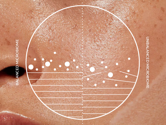 Close-up of skin texture with a circular graph overlay. The graph displays "Balanced Microbiome" on the left and "Unbalanced Microbiome" on the right, with various data points and lines illustrating differences.