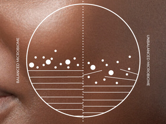 Close-up of a person's cheek with a diagram overlay. The diagram is split into two halves: the left labeled "Balanced Microbiome" with fewer dots and lines; the right labeled "Unbalanced Microbiome" with more dots and uneven lines.